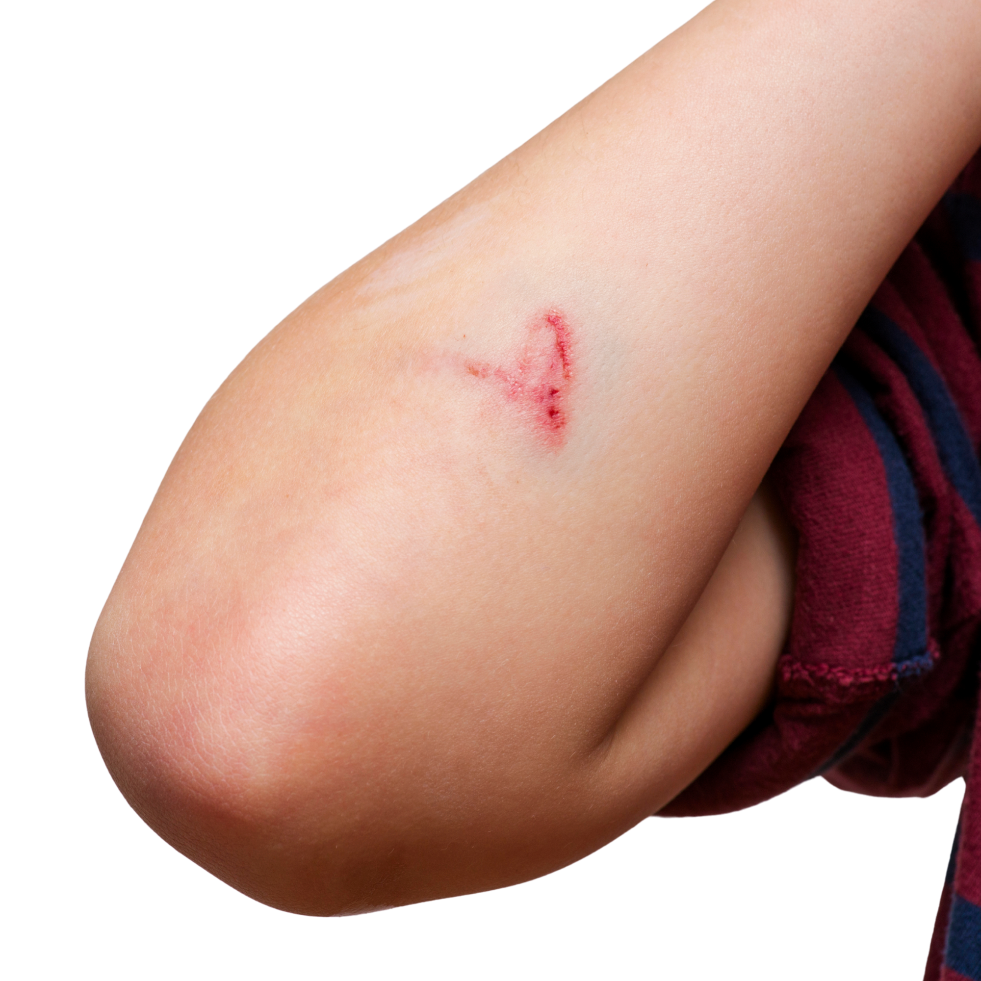 Cut on elbow